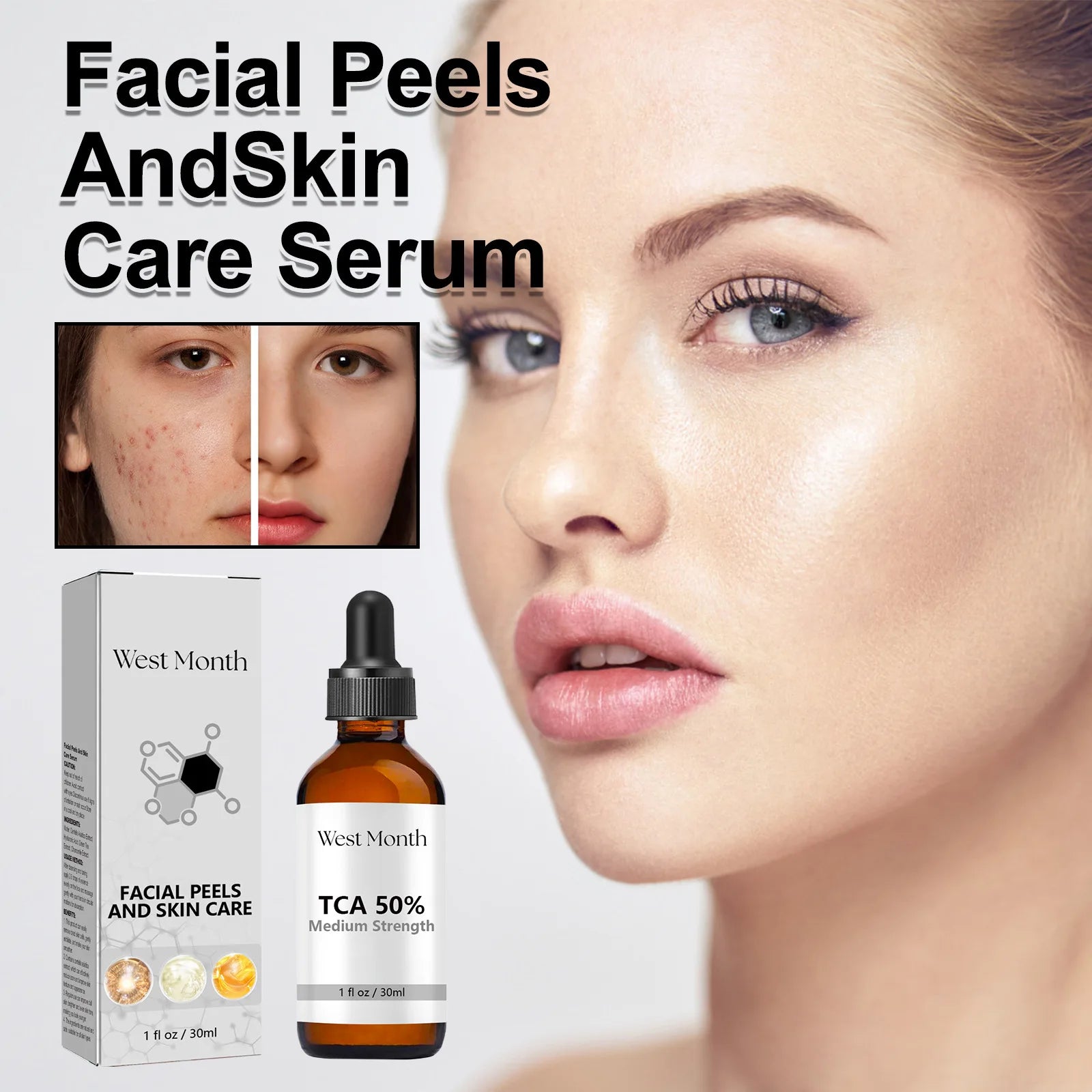 Acne Treatment Serum