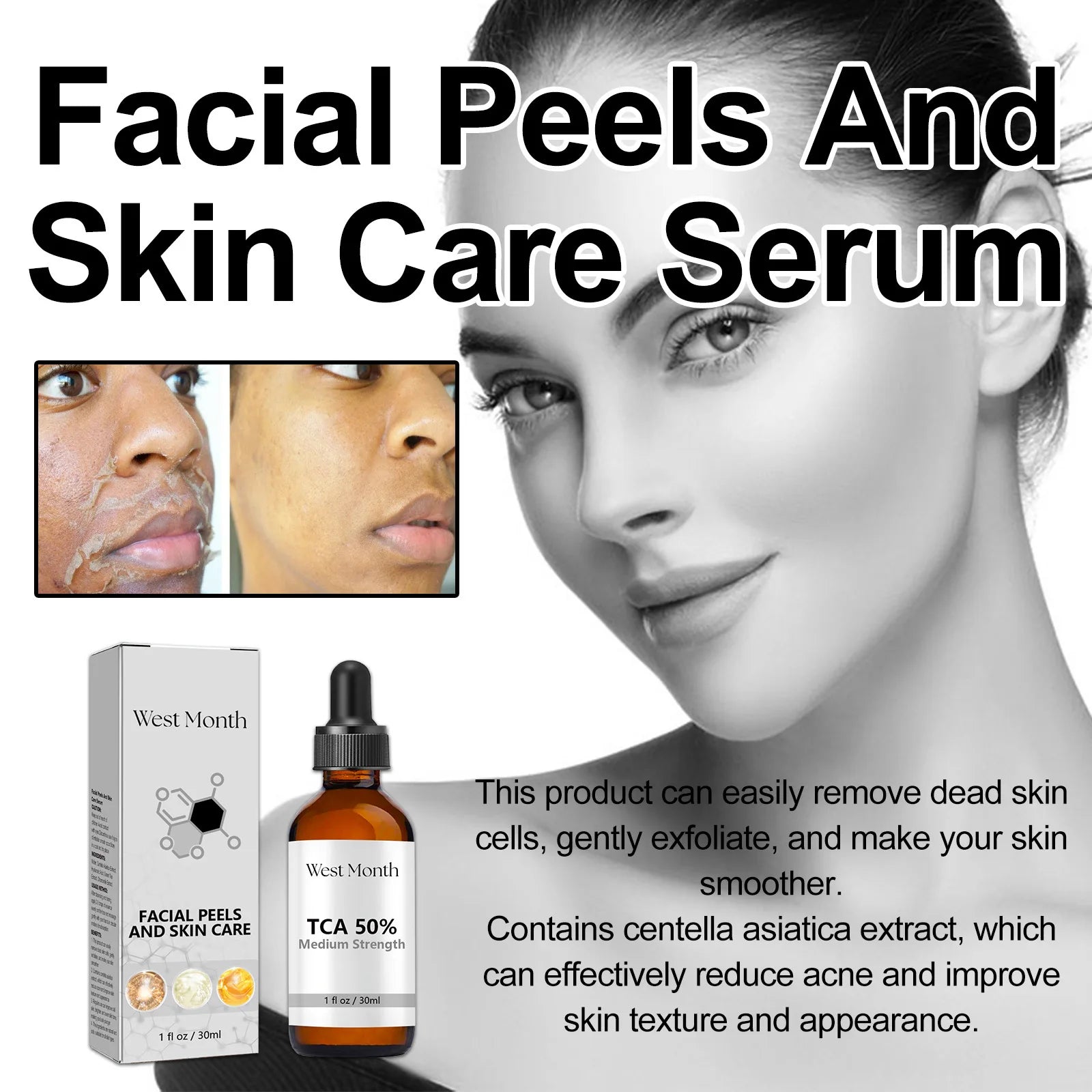 Acne Treatment Serum
