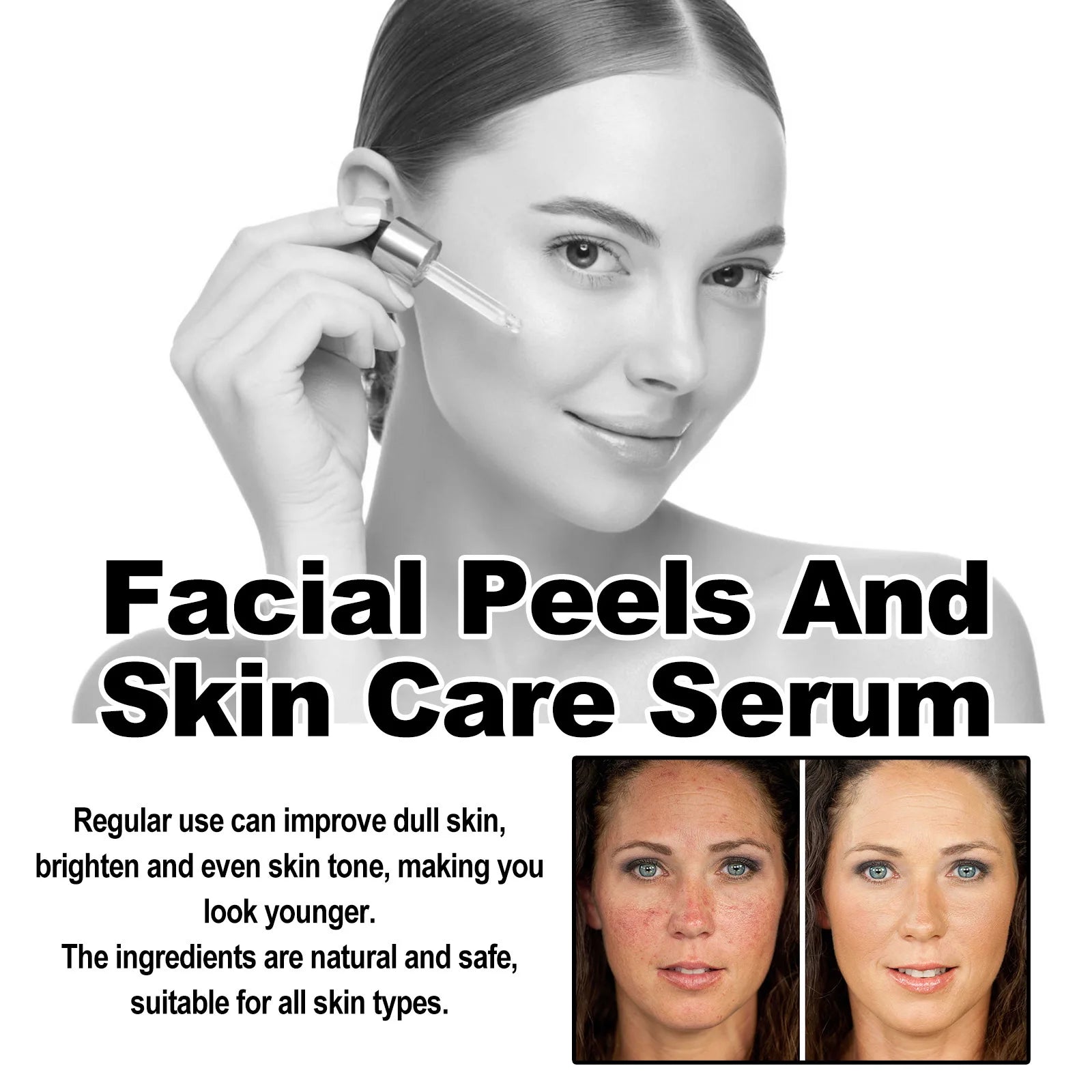 Acne Treatment Serum