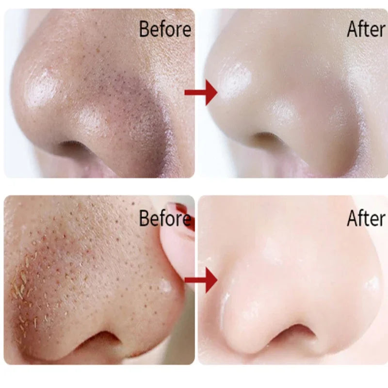 Nose Blackhead Remover Mask