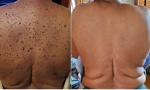Skinkare Moles Removal Cream