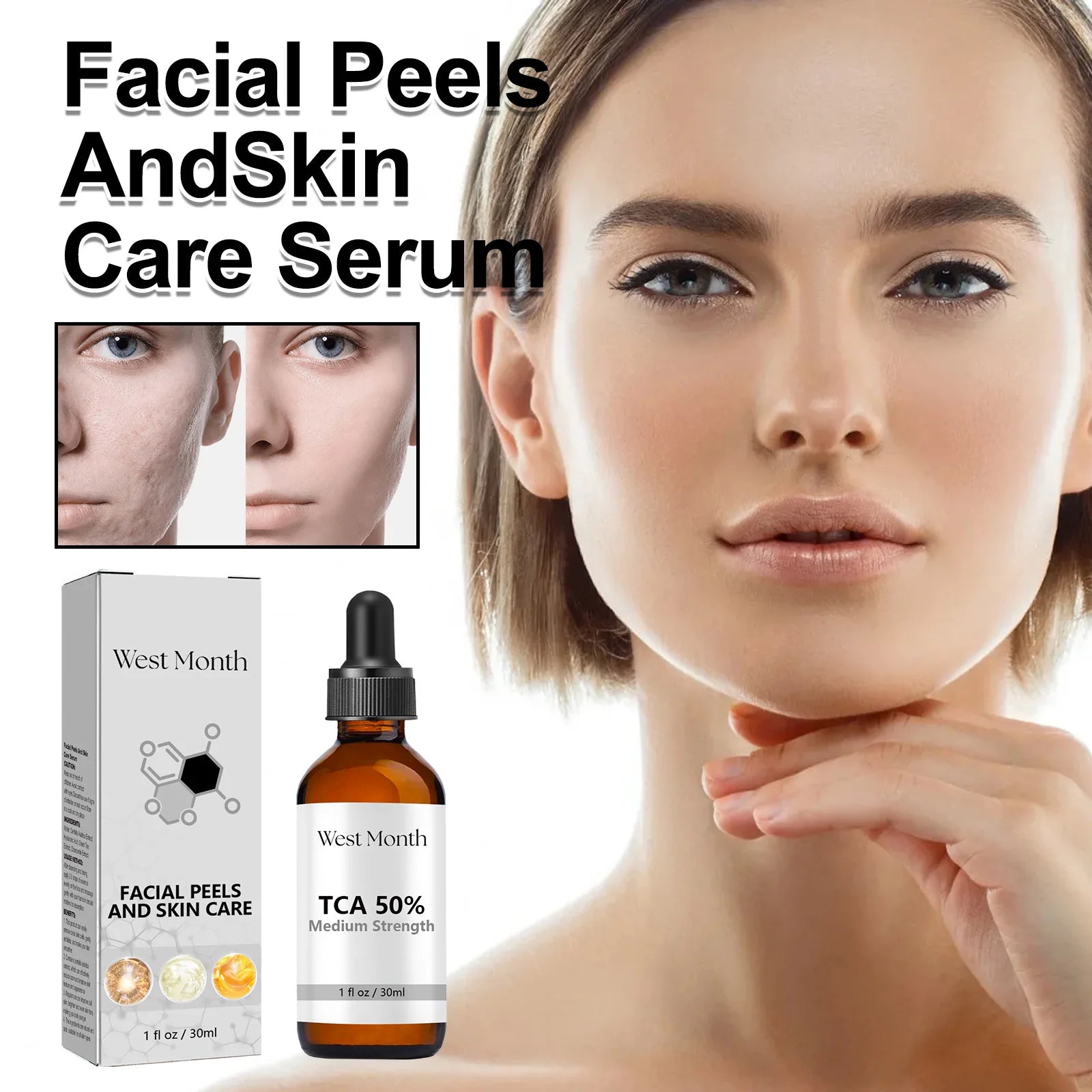 Acne Treatment Serum