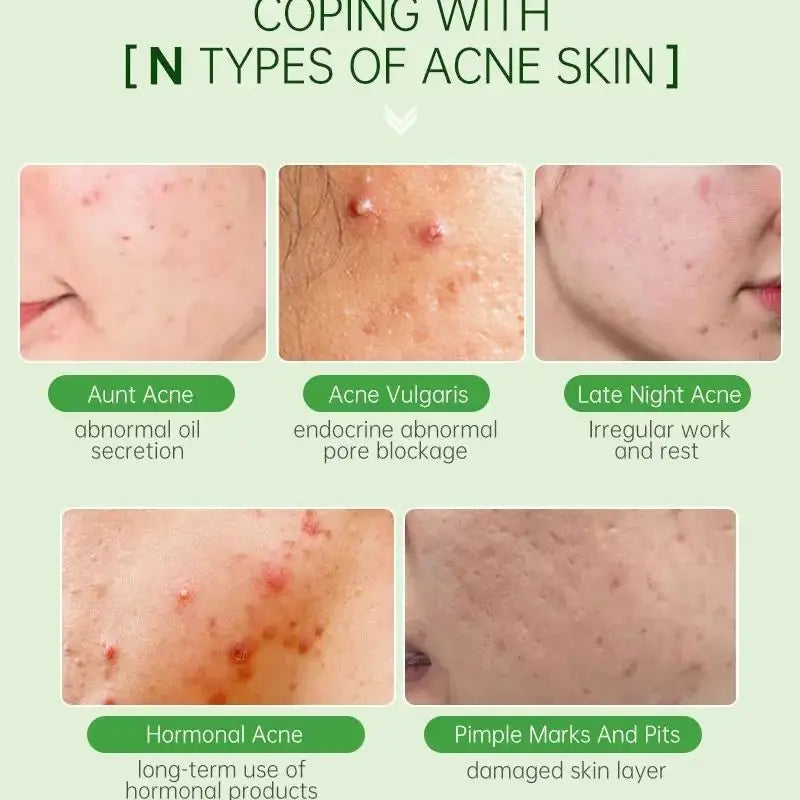 Tea Tree Acne Serum Oil